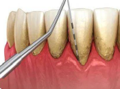 深圳牙科牙醫解答牙齦萎縮有邊啲症狀？