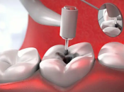 大陸牙醫補牙唔同材料優點？維港口腔補牙有保養嗎？