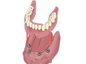 一次帶你了解深圳All on 4植牙！深圳全口種牙邊度好？