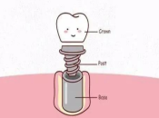 深圳維港口腔植牙——植牙可以用幾耐？術後要注意咩？