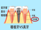 深圳維港口腔種植牙科普|種植牙嘅咀嚼功能真係同真牙一樣？