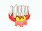 點樣判斷患咗牙周炎，深圳治療牙周炎邊度好？