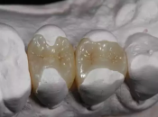 深圳牙醫話除咗普通補牙，仲能夠用嵌體補牙修復？嵌體係咩？