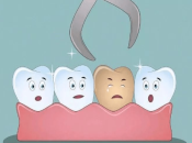 剝牙後個窿幾時可以生好？深圳剝牙收費？