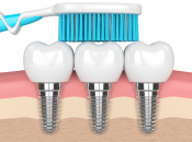 落馬洲口岸牙科維港口腔科普：植牙後刷牙有咩要注意？