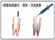 深圳牙科杜牙根收費？杜牙根一定要按時複診？