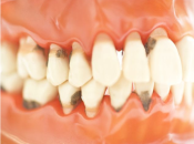 深圳牙醫解答：如何讓牙周病嘅治療效果更長久?