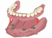 深圳all-on-4/6半口植牙同可拆式半口植牙嘅區別？
