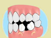 深圳維港口腔植牙——植牙前點解要調整對咬牙同鄰牙咧？