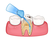 牙根發炎係乜情況？牙根發炎上深圳治療牙齒推薦！