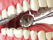 侵襲性牙周炎臨床表現及治療