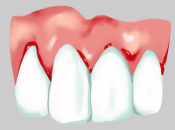 深圳牙周治療——慢性牙齦炎有哪些呢？