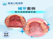 深圳補牙邊家方便價格又划算？銀粉補牙可以換成樹脂補牙嗎？