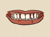 深圳牙醫講解：牙齦出血亦都係病，如果牙齒開始松咗就大禍啦！