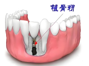 牙醫話我種牙前要先植骨？深圳邊間牙科植牙穩陣？