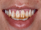 深圳牙科有咩方法可改善治療氟斑牙？
