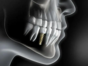 種植體有幾種類型？深圳邊度種牙好？深圳種牙牙科推介
