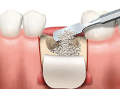 深圳牙科種植牙嘅骨粉骨膜系咩？有咩作用？