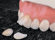 瓷牙貼片是否能夠治療變色牙？深圳牙齒貼片貴唔貴？