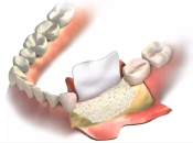 植牙前植骨嘅材料有咩？植骨會傷害身體嗎？深圳牙科植牙幾錢？