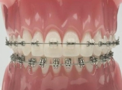 深圳箍牙貴嗎？箍牙費用到底貴在哪里？
