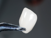 深圳瓷牙貼片修復過程如何？是否靠譜？