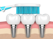 深圳植牙後日常刷牙要注意咩咧？深圳牙科植牙收費標準2024