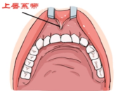 深圳牙齒美白——牙齦有問題還可以進行貼面或者瓷牙套嗎？