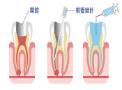 牙痛就要杜牙根嗎？維港口腔杜牙根收費標準