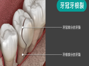 深圳種牙討論：牙裂係唔係就要剝牙植牙咧？