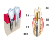 深圳植牙選擇牙釘須知！深圳植牙價目表2023