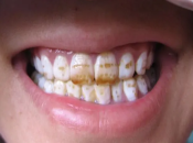深圳牙醫對於氟斑牙有邊啲治療方法？