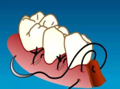 深圳維港牙醫解答：邊啲好習慣可以幫助你擺脫牙周病？