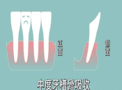 牙槽骨吸收太嚴重仲可唔可以種牙？深圳平靚正種植牙推薦