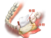 深圳植牙乜情況要加骨粉？有危險嗎？深圳植牙幾錢？