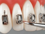 影響成人箍牙時間嘅因素有咩咧？大陸箍牙去邊間牙科好？