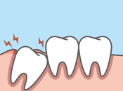 智慧齒經常發炎幾時剝比較好？深圳脫智慧齒幾錢？