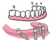 深圳植牙後續，過渡義齒點選擇？深圳牙醫解答