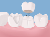 烤瓷牙同全瓷牙有咩分別？深圳牙冠幾錢？