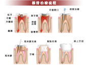 深圳杜牙根，杜牙根過程系點樣嘅？需2-4次復診？