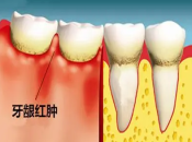 牙周炎唔理會對全身健康造成影響？深圳有冇牙周專科推介？