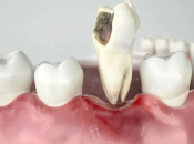 蛀牙/牙周病會唔會遺傳？大陸整牙牙科邊間好？