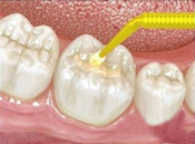大陸補牙價錢，補牙後出現牙齒酸軟系咩原因？