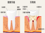 深圳牙周治療幾錢？有牙周病點解要盡快治療？