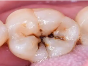 深圳補牙—箍牙是否容易蛀牙？容易蛀牙嘅四大人群！