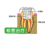 杜牙根通常需要幾長時間？深圳杜牙根收費貴唔貴？