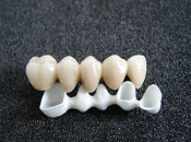 邊啲牙齒情況適合做全瓷牙套修復？