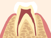 深圳箍牙—咩原因會導致牙根短咧？