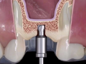 深圳維港口腔植牙—上頜竇提升術係咩咧？