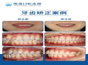 深圳箍牙選牙齒隱形矯正和傳統金屬牙套有哪些區別？